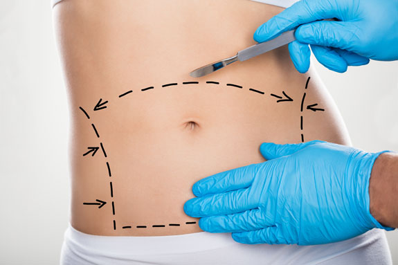 Abdominoplastik Mayen