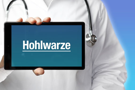 Schlupfwarzen Mayen